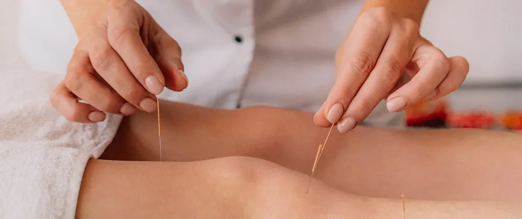 Acupuncture: Your Essential Guide to Stress and Anxiety Relief