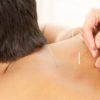 Acupuncture and Cupping Enhance Sports Recovery Effectively