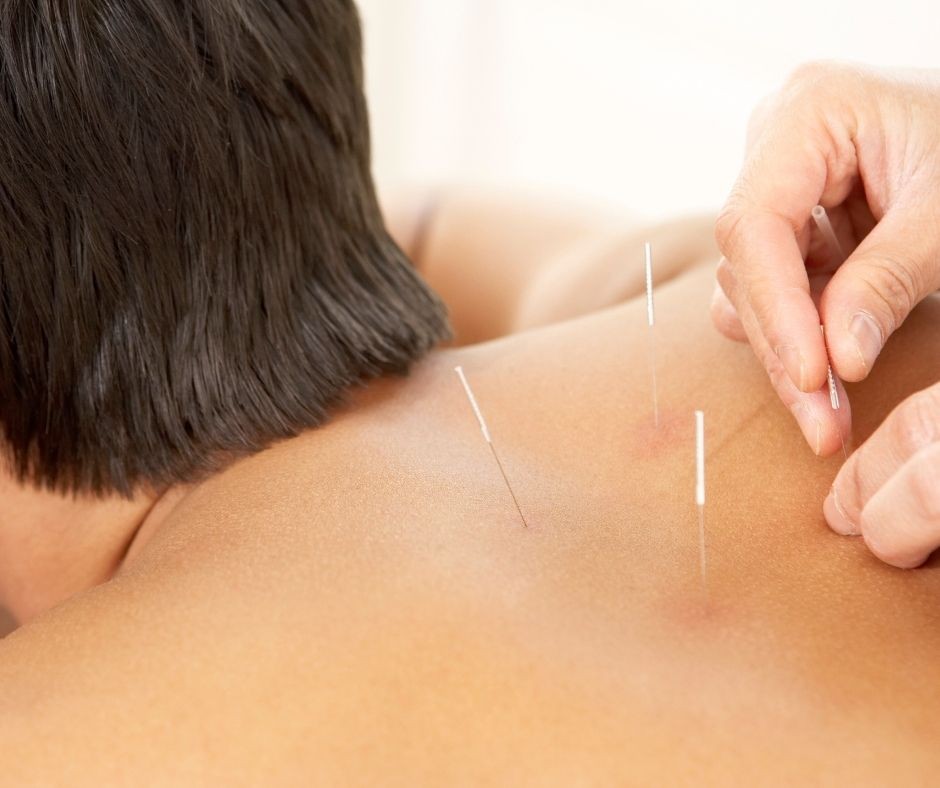 Acupuncture and Cupping Enhance Sports Recovery Effectively