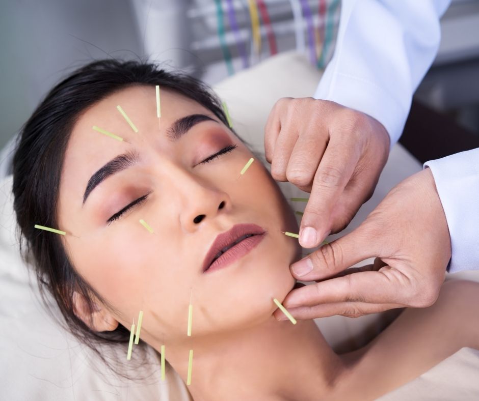 Cosmetic Acupuncture: Key Drawbacks You Should Know